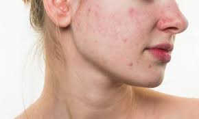 Rosacea Treatment
